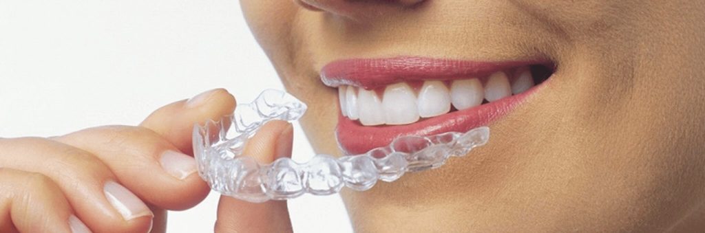 капа для зубов на ночь от «Стоматология Татьяны Коновой»